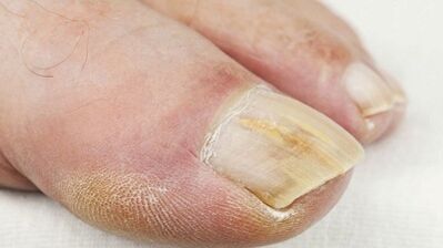 A gomba fejlődésének kezdeti szakasza a körmökön