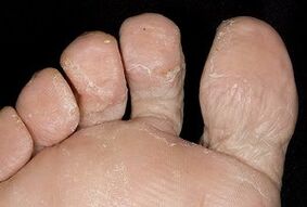A láb bőre gombás fertőzéssel