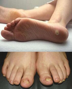 A mycosis megnyilvánulásai a láb bőrén és körmein