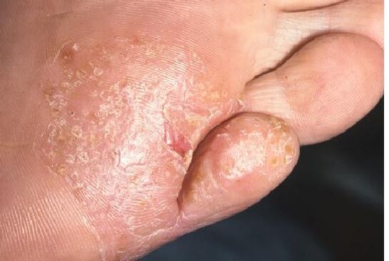 A gombás fertőzés megnyilvánulásai a láb bőrén